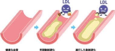 血管と動脈硬化の図